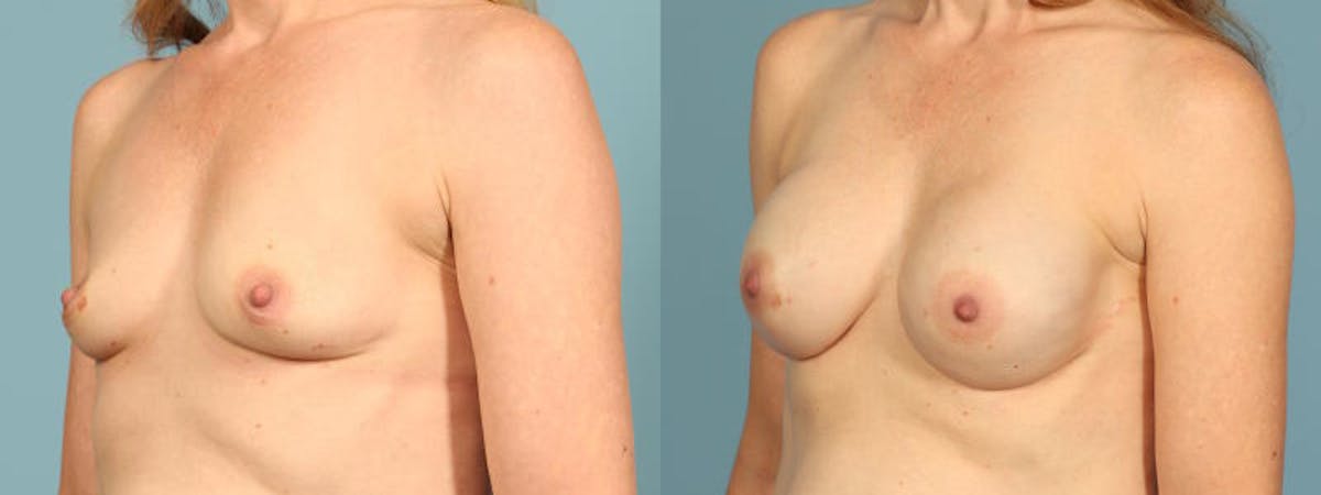 Direct to Implant Reconstruction Before & After Gallery - Patient 325390 - Image 2