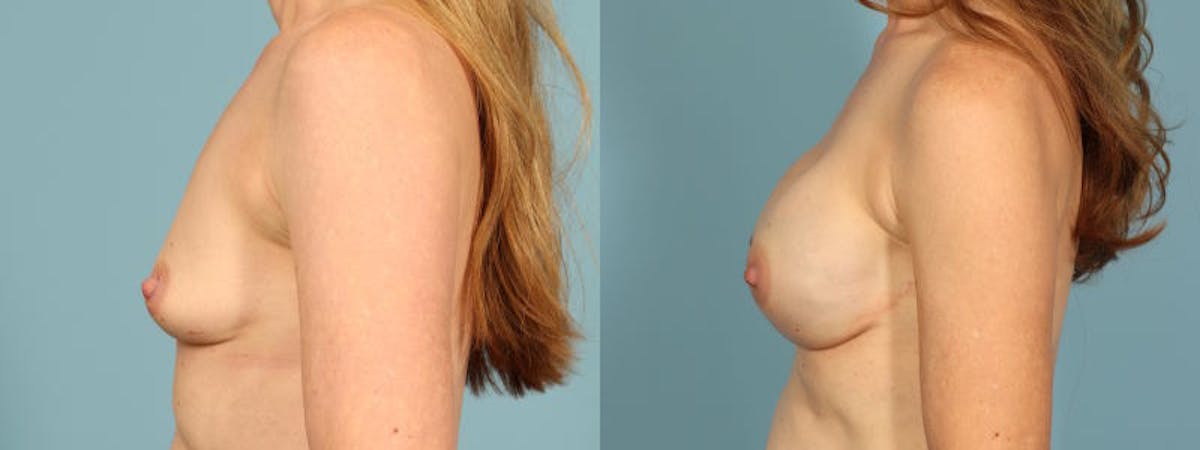 Direct to Implant Reconstruction Before & After Gallery - Patient 325390 - Image 4