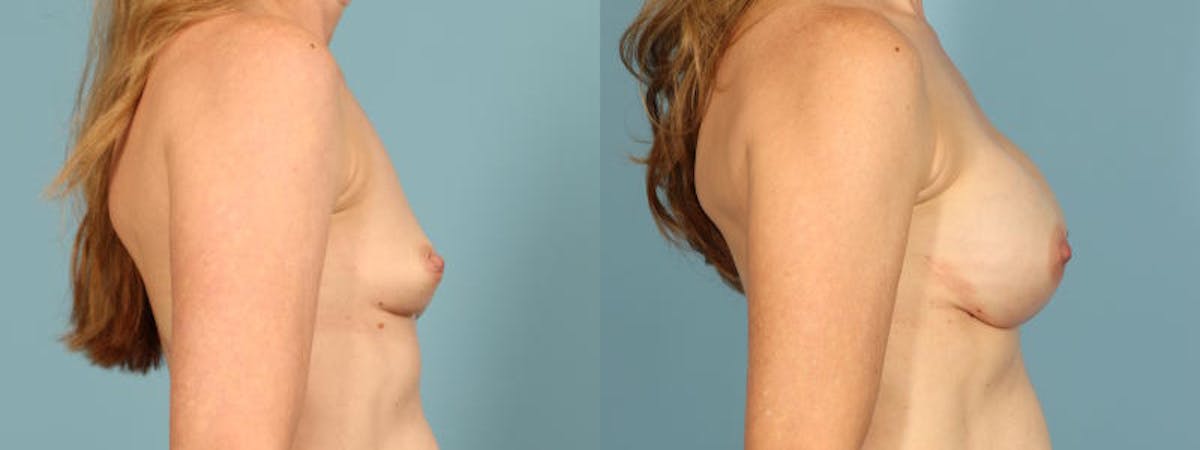 Direct to Implant Reconstruction Before & After Gallery - Patient 325390 - Image 5