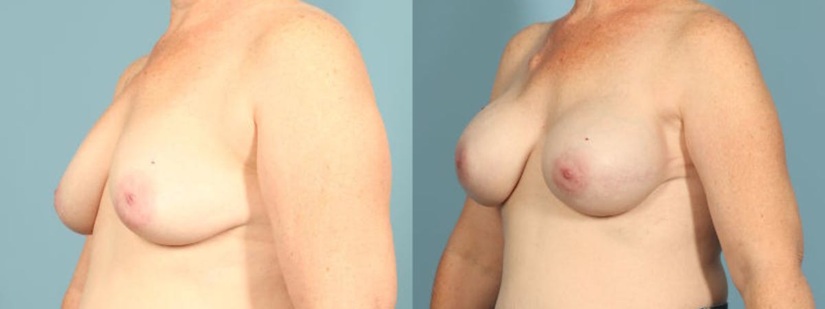 Direct to Implant Reconstruction Before & After Gallery - Patient 160146 - Image 2