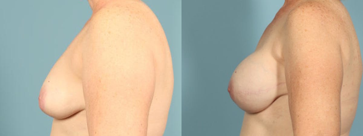 Direct to Implant Reconstruction Before & After Gallery - Patient 160146 - Image 4