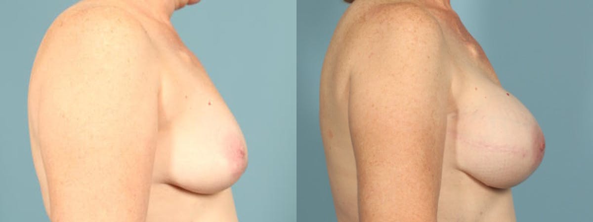 Direct to Implant Reconstruction Before & After Gallery - Patient 160146 - Image 5