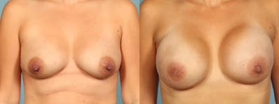 Direct to Implant Reconstruction Before & After Gallery - Patient 563031 - Image 1