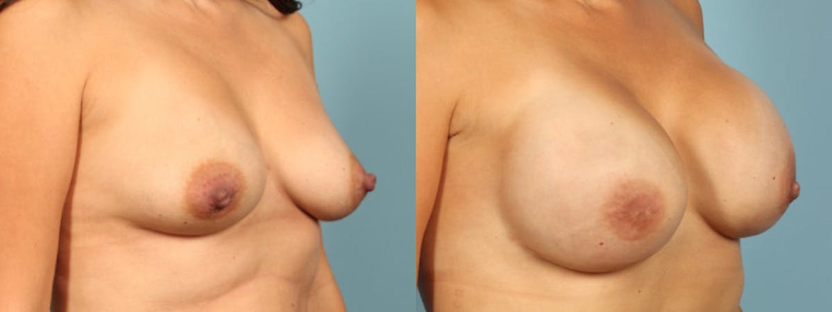 Direct to Implant Reconstruction Before & After Gallery - Patient 563031 - Image 3