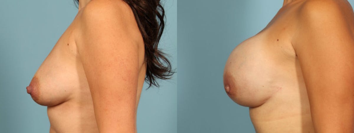 Direct to Implant Reconstruction Before & After Gallery - Patient 563031 - Image 4