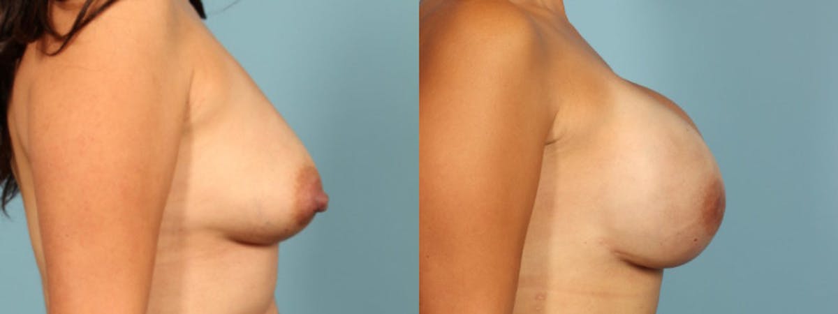 Direct to Implant Reconstruction Before & After Gallery - Patient 563031 - Image 5