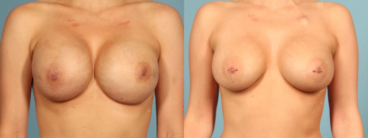 Direct to Implant Reconstruction Before & After Gallery - Patient 310652 - Image 1