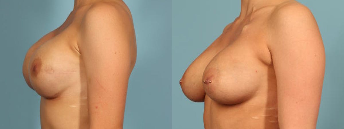 Direct to Implant Reconstruction Before & After Gallery - Patient 310652 - Image 2