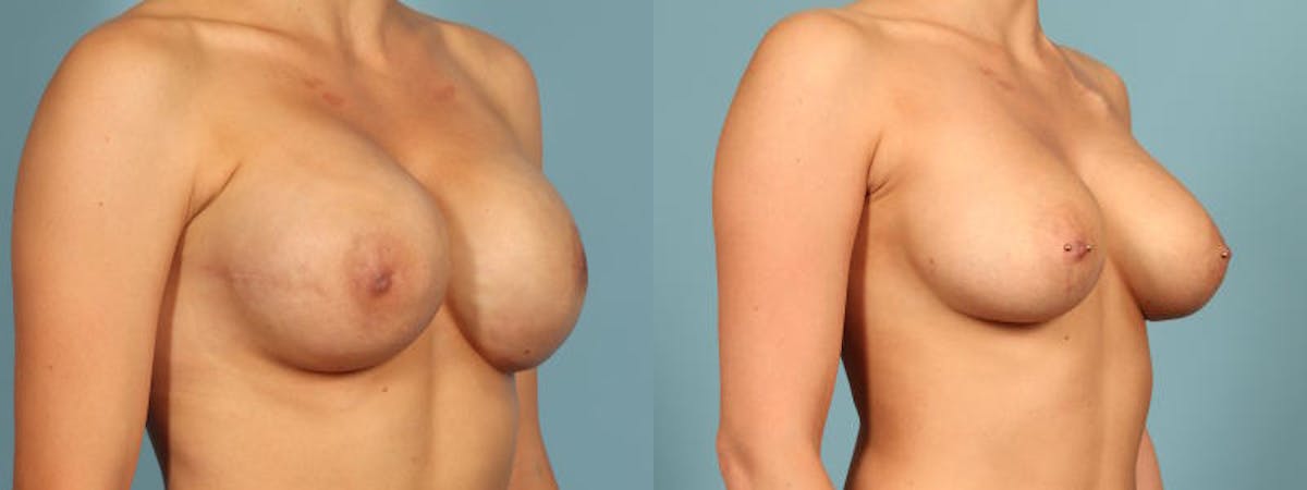 Direct to Implant Reconstruction Before & After Gallery - Patient 310652 - Image 3