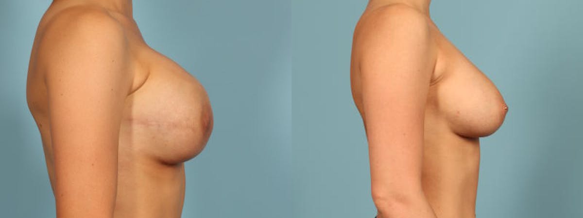 Direct to Implant Reconstruction Before & After Gallery - Patient 310652 - Image 4