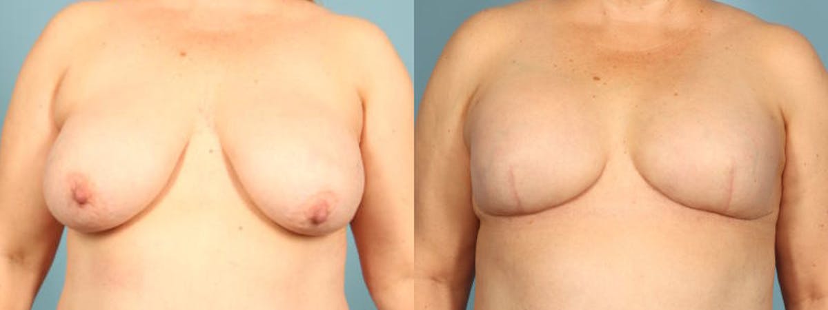 Direct to Implant Reconstruction Before & After Gallery - Patient 867302 - Image 1