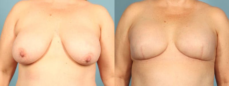 Direct to Implant Reconstruction Before & After Gallery - Patient 867302 - Image 1