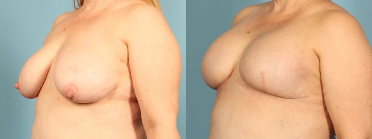 Direct to Implant Reconstruction Before & After Gallery - Patient 867302 - Image 2