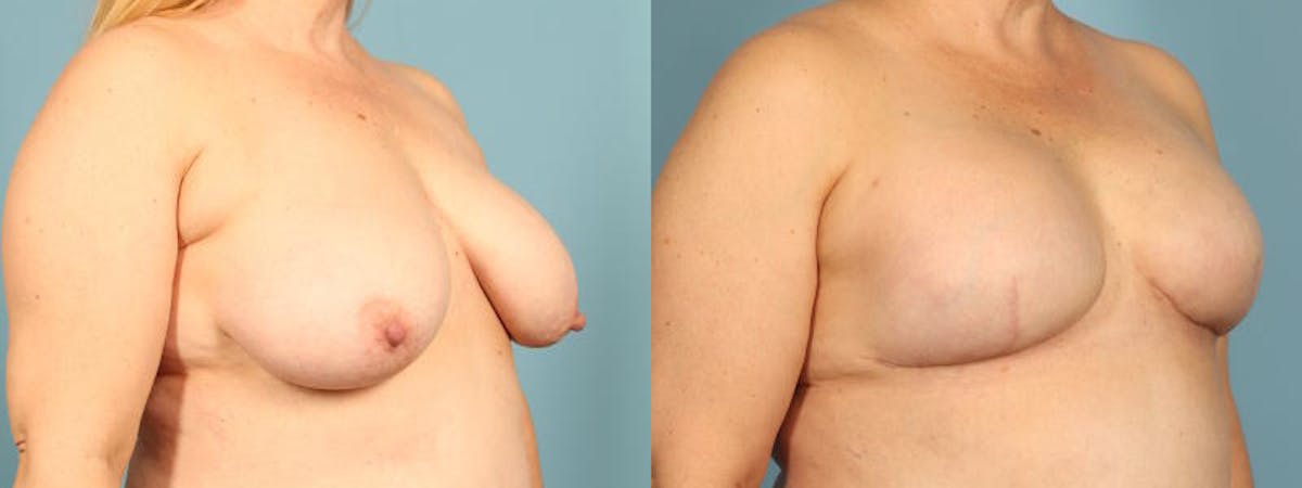Direct to Implant Reconstruction Before & After Gallery - Patient 867302 - Image 3