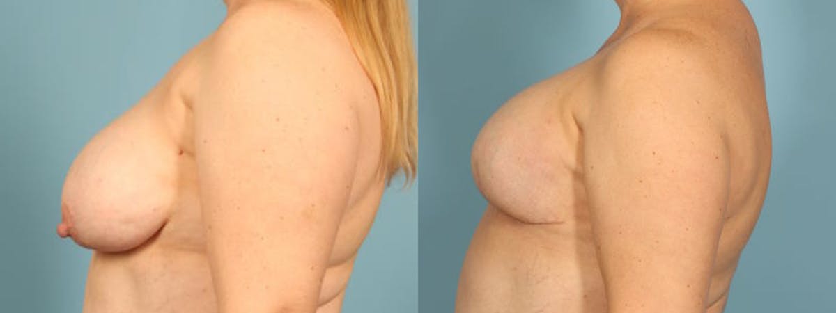Direct to Implant Reconstruction Before & After Gallery - Patient 867302 - Image 4