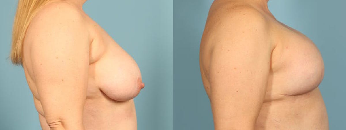 Direct to Implant Reconstruction Before & After Gallery - Patient 867302 - Image 5