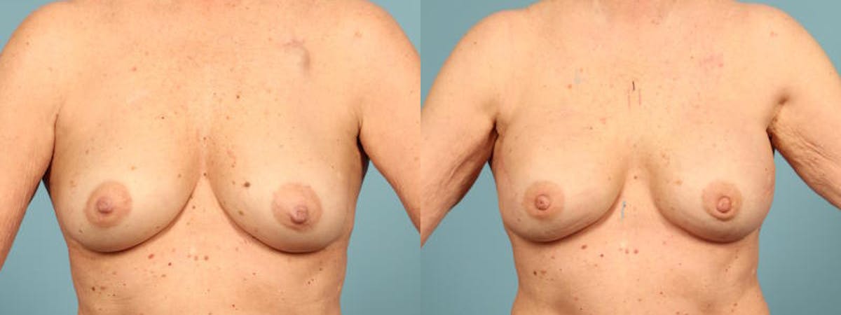 Direct to Implant Reconstruction Before & After Gallery - Patient 259553 - Image 1
