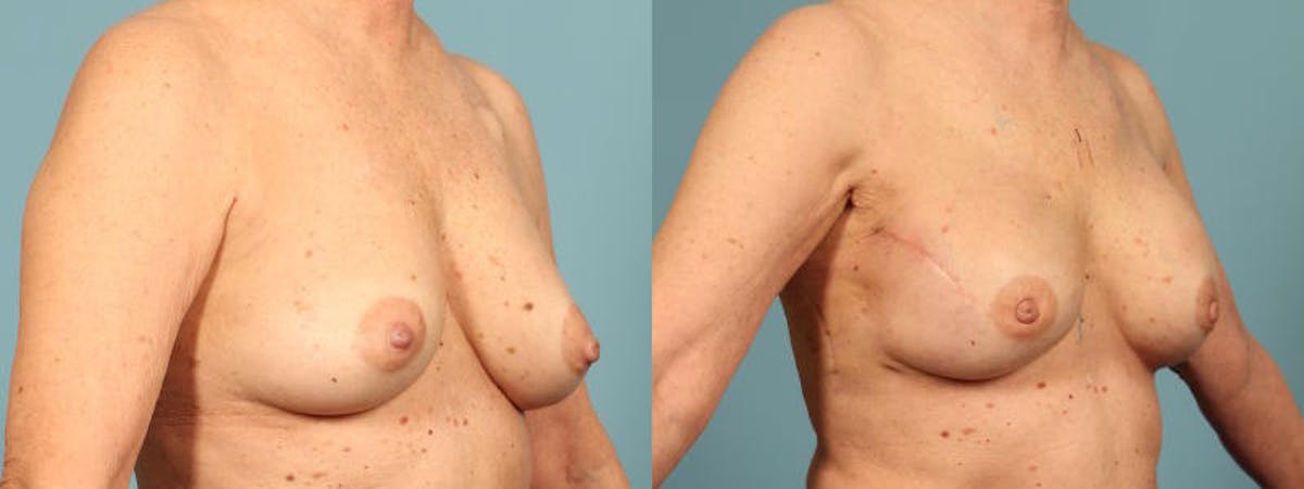 Direct to Implant Reconstruction Before & After Gallery - Patient 259553 - Image 3