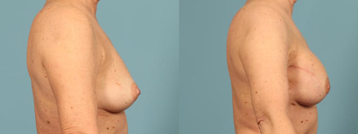 Direct to Implant Reconstruction Before & After Gallery - Patient 259553 - Image 4