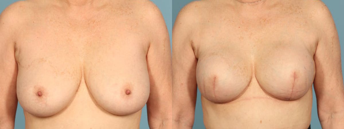 Direct to Implant Reconstruction Before & After Gallery - Patient 106500 - Image 1