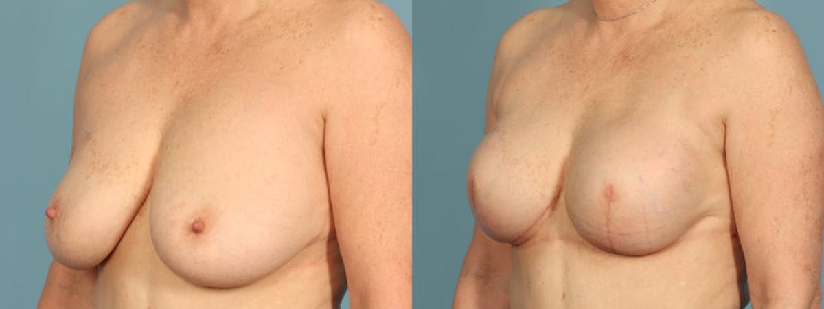 Direct to Implant Reconstruction Before & After Gallery - Patient 106500 - Image 2