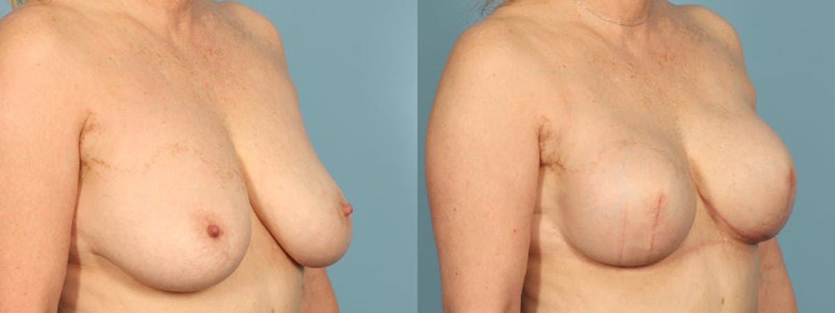 Direct to Implant Reconstruction Before & After Gallery - Patient 106500 - Image 3