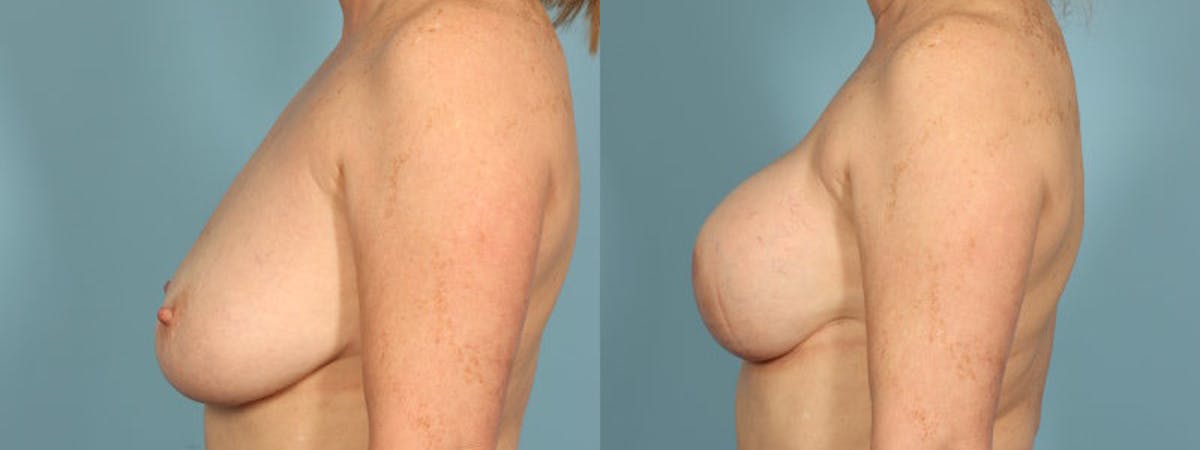 Direct to Implant Reconstruction Before & After Gallery - Patient 106500 - Image 4