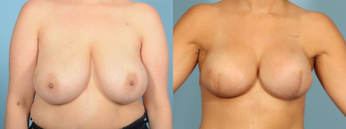 Direct to Implant Reconstruction Before & After Gallery - Patient 323042 - Image 1