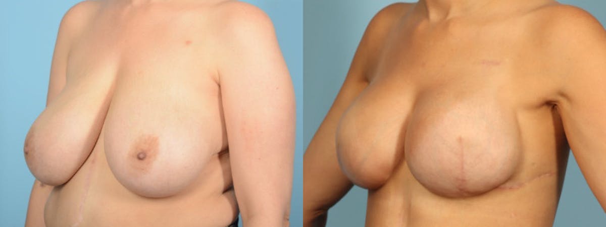 Direct to Implant Reconstruction Before & After Gallery - Patient 323042 - Image 2