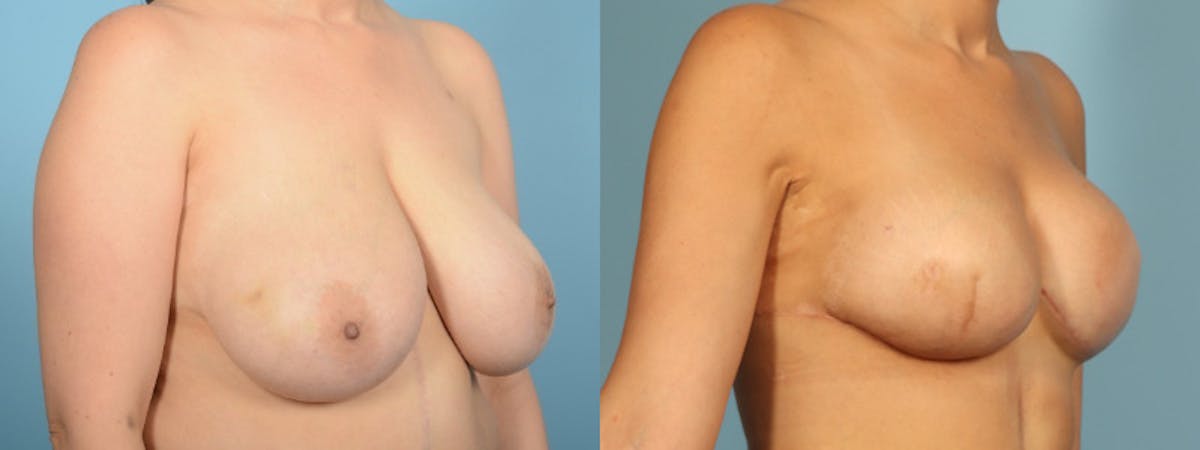 Direct to Implant Reconstruction Before & After Gallery - Patient 323042 - Image 3