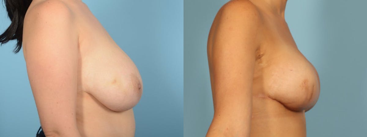 Direct to Implant Reconstruction Before & After Gallery - Patient 323042 - Image 4