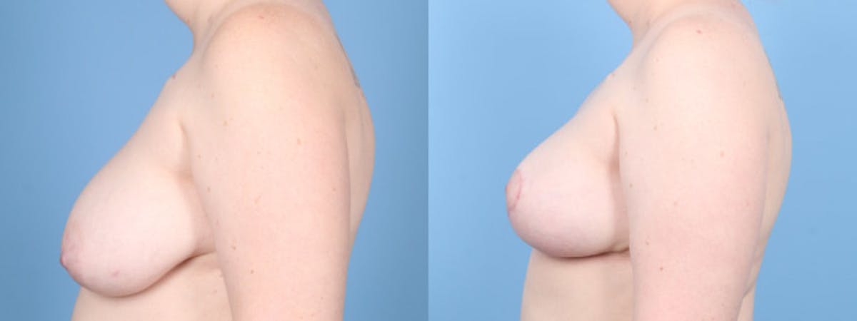 Oncoplastic Reconstruction Before & After Gallery - Patient 929716 - Image 5