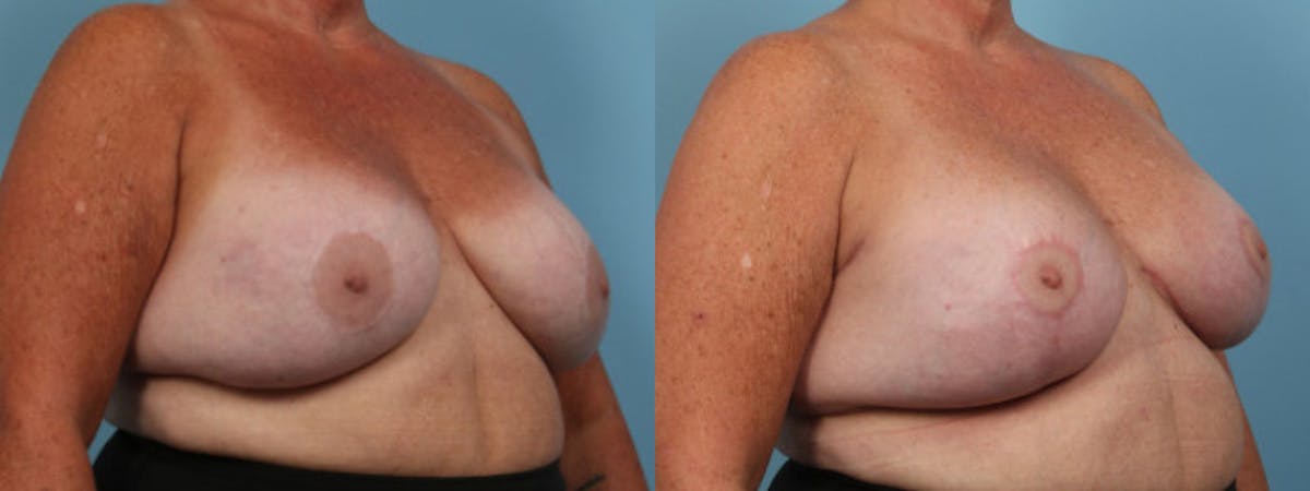 Oncoplastic Reconstruction Before & After Gallery - Patient 330708 - Image 2