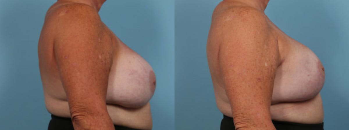 Oncoplastic Reconstruction Before & After Gallery - Patient 330708 - Image 3