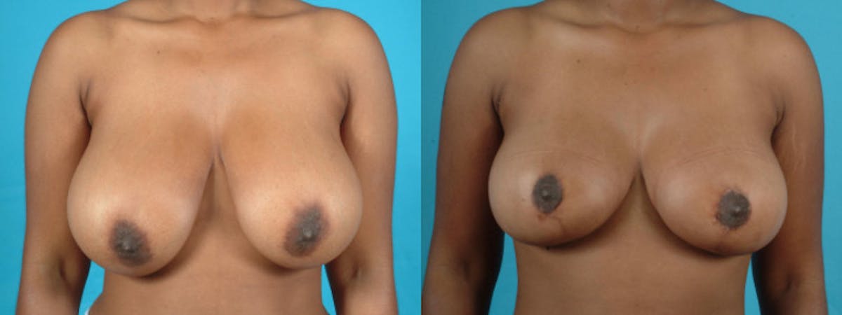 Oncoplastic Reconstruction Before & After Gallery - Patient 116386 - Image 1