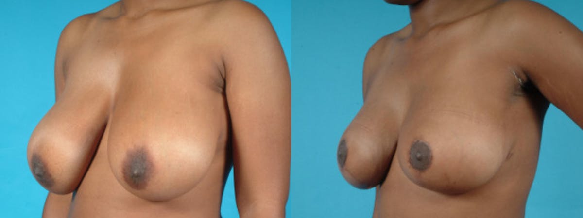 Oncoplastic Reconstruction Before & After Gallery - Patient 116386 - Image 3