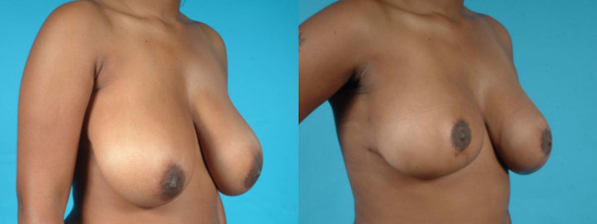 Oncoplastic Reconstruction Before & After Gallery - Patient 116386 - Image 4