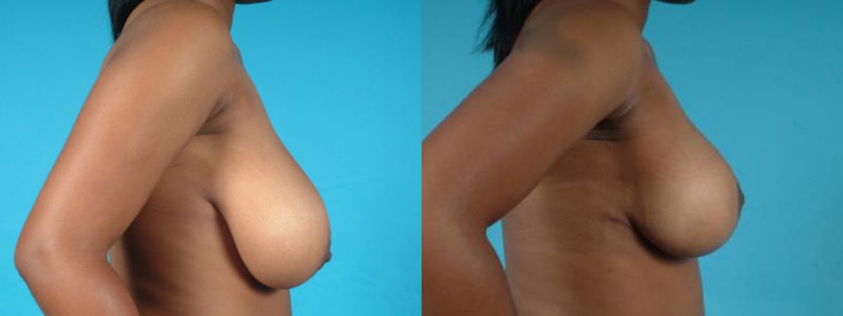 Oncoplastic Reconstruction Before & After Gallery - Patient 116386 - Image 6