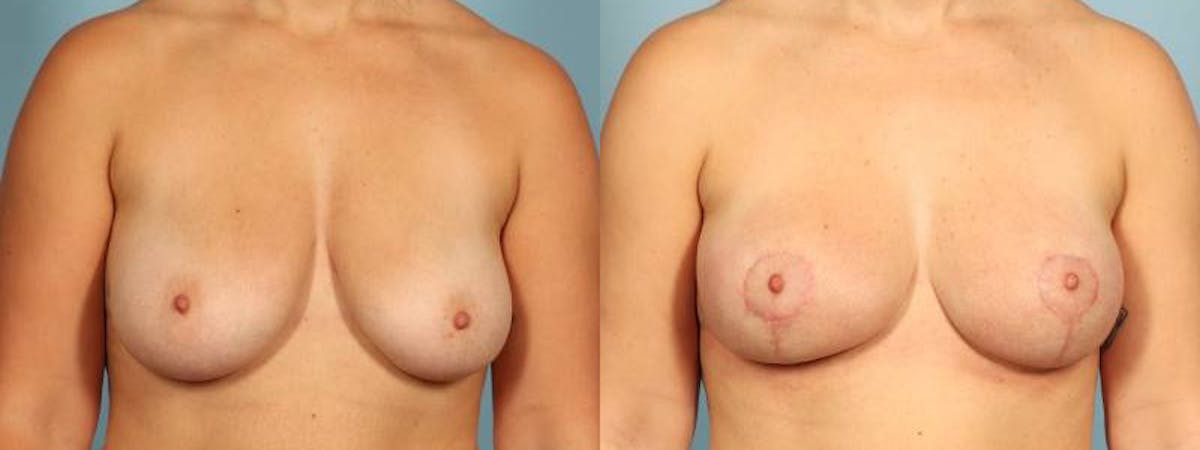 Oncoplastic Reconstruction Before & After Gallery - Patient 305331 - Image 1