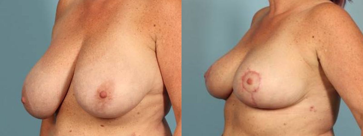Oncoplastic Reconstruction Before & After Gallery - Patient 706451 - Image 2