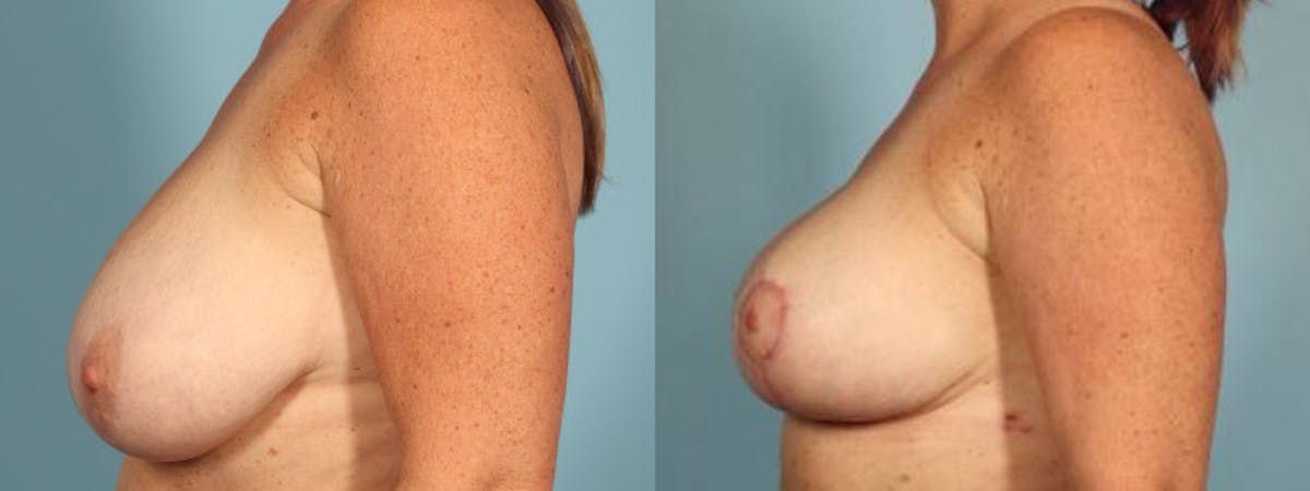 Oncoplastic Reconstruction Before & After Gallery - Patient 706451 - Image 4