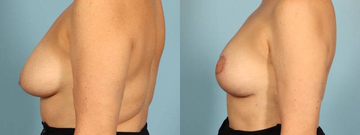 Oncoplastic Reconstruction Before & After Gallery - Patient 880142 - Image 4