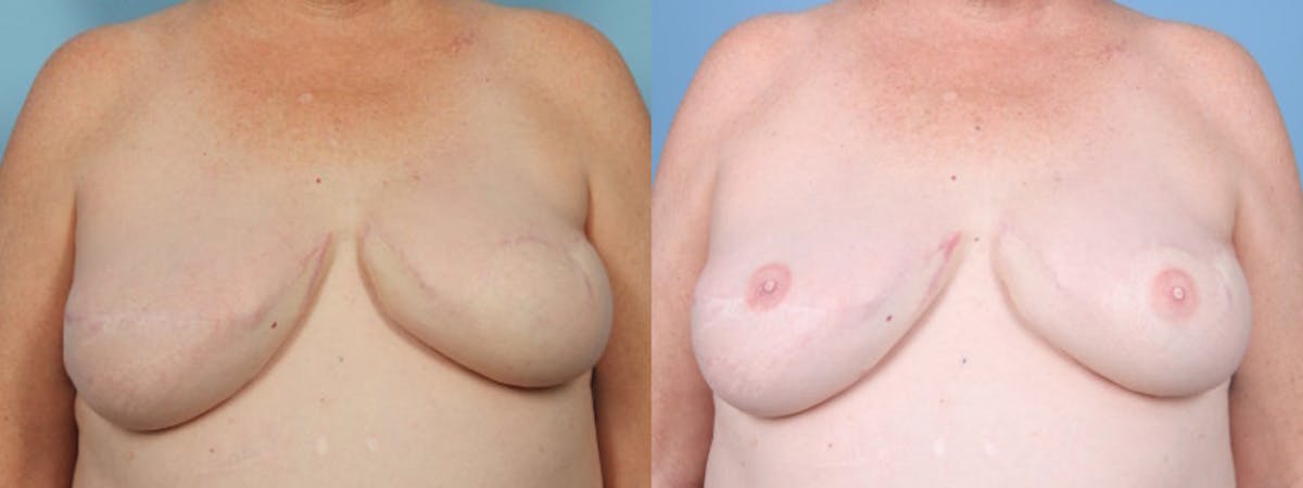 3D Nipple Tattoo Before & After Gallery - Patient 793864 - Image 1