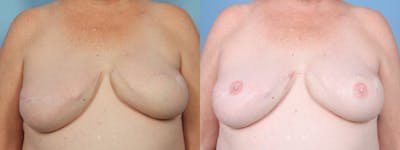 3D Nipple Tattoo Before & After Gallery - Patient 793864 - Image 1