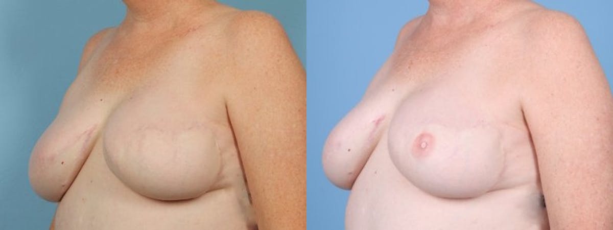 3D Nipple Tattoo Before & After Gallery - Patient 793864 - Image 3