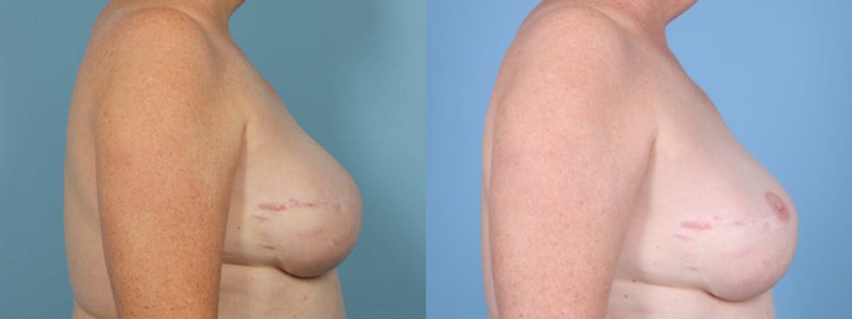 3D Nipple Tattoo Before & After Gallery - Patient 793864 - Image 4