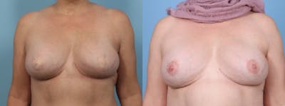 3D Nipple Tattoo Before & After Gallery - Patient 263554 - Image 1