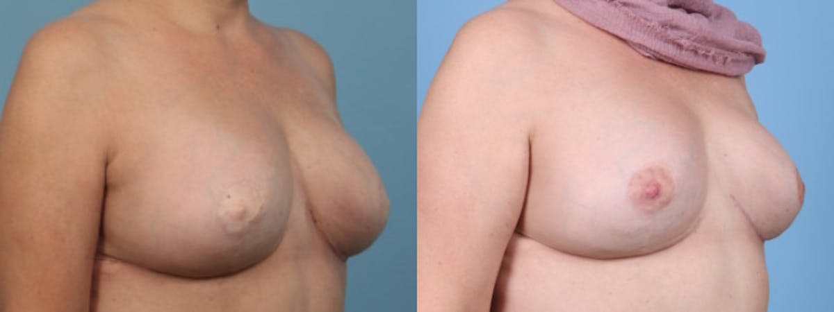 3D Nipple Tattoo Before & After Gallery - Patient 263554 - Image 2