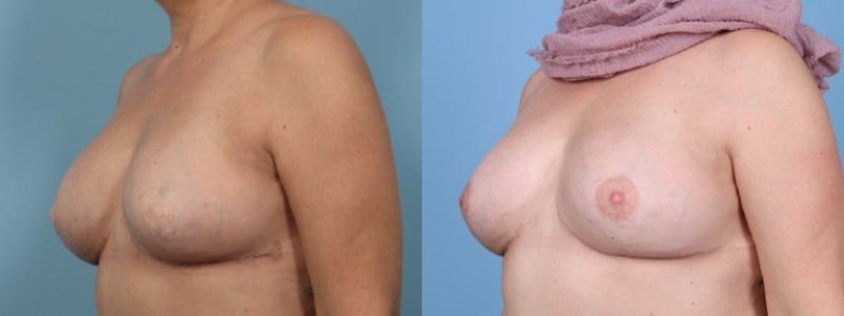 3D Nipple Tattoo Before & After Gallery - Patient 263554 - Image 3