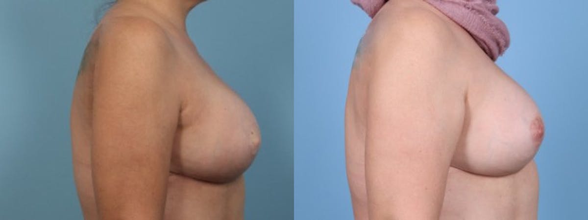 3D Nipple Tattoo Before & After Gallery - Patient 263554 - Image 5